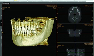 Преимущества 3D технологий в Компьютерной Томографии (стоматология, травматология)