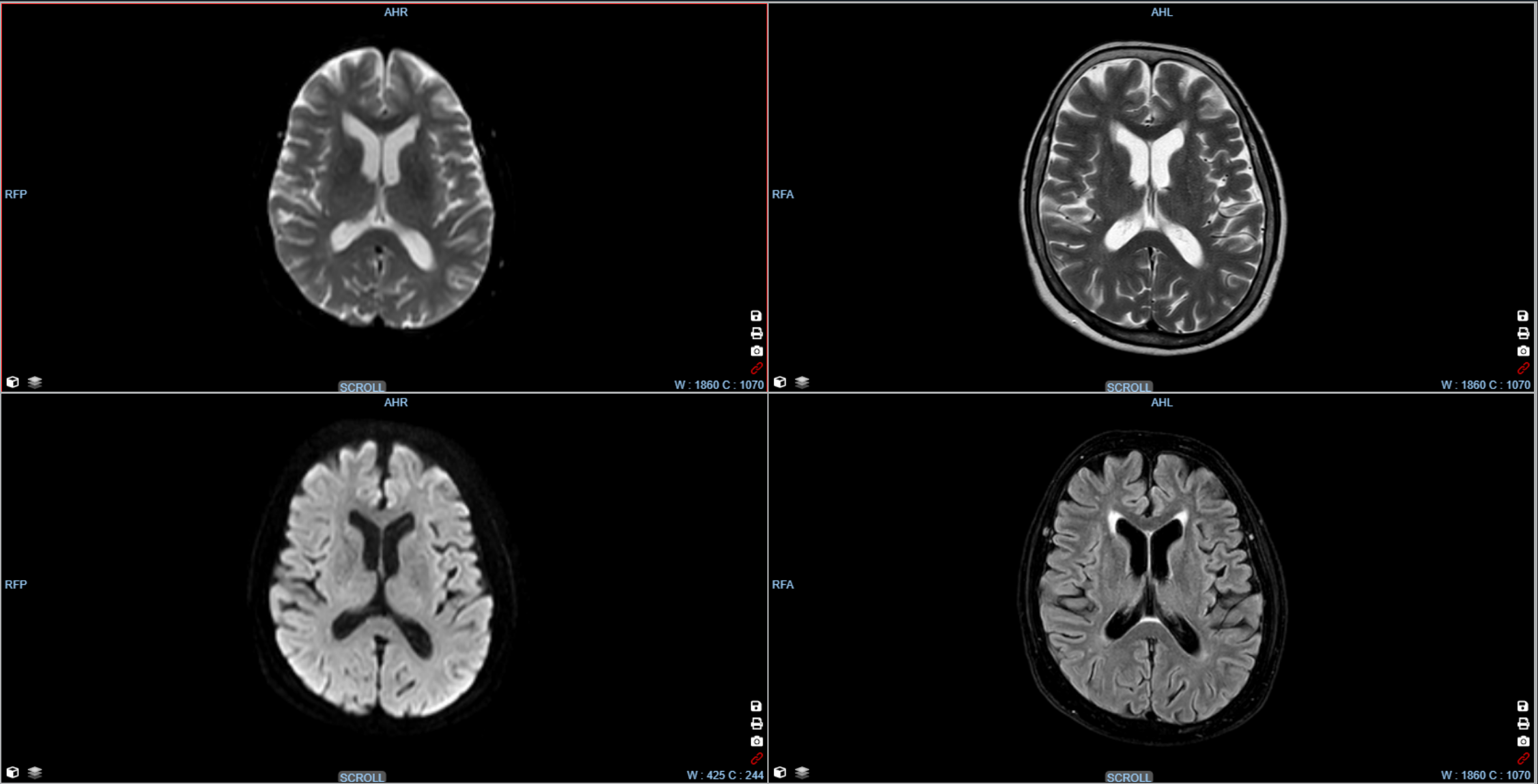 Kometa Workstation MRI — Brain Perfusion