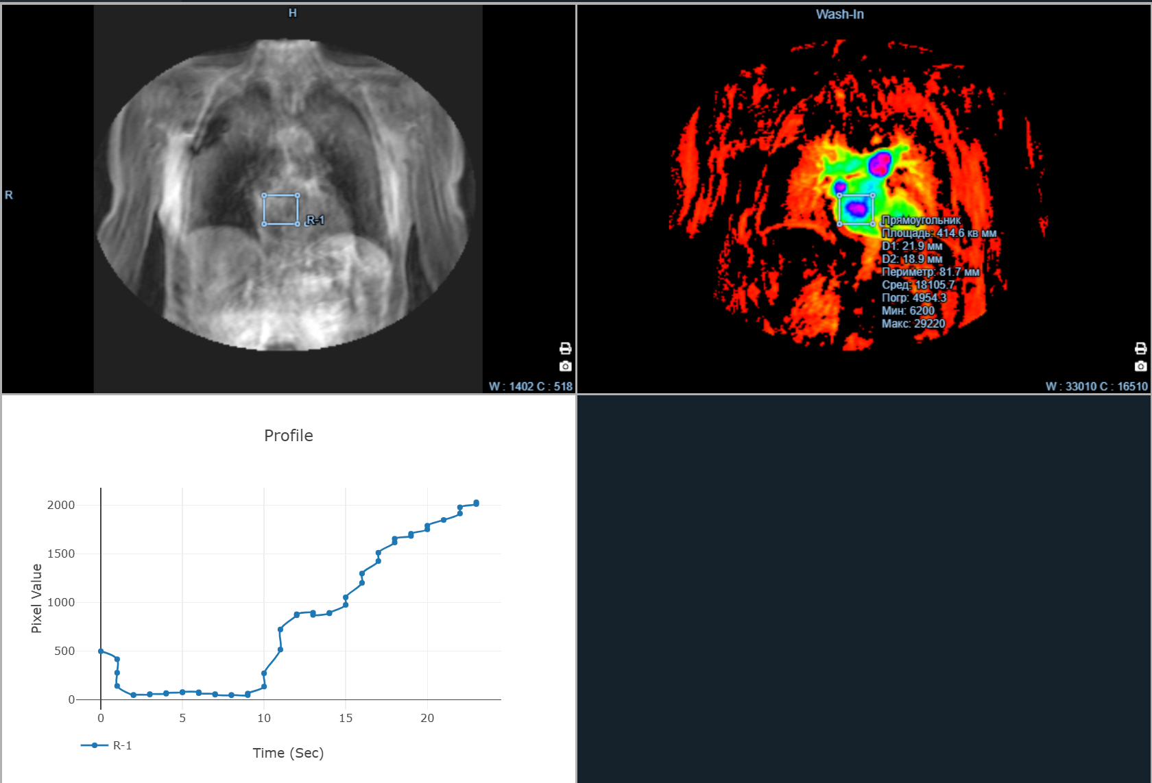 Kometa Workstation MRI — Advanced Vessel Analysis