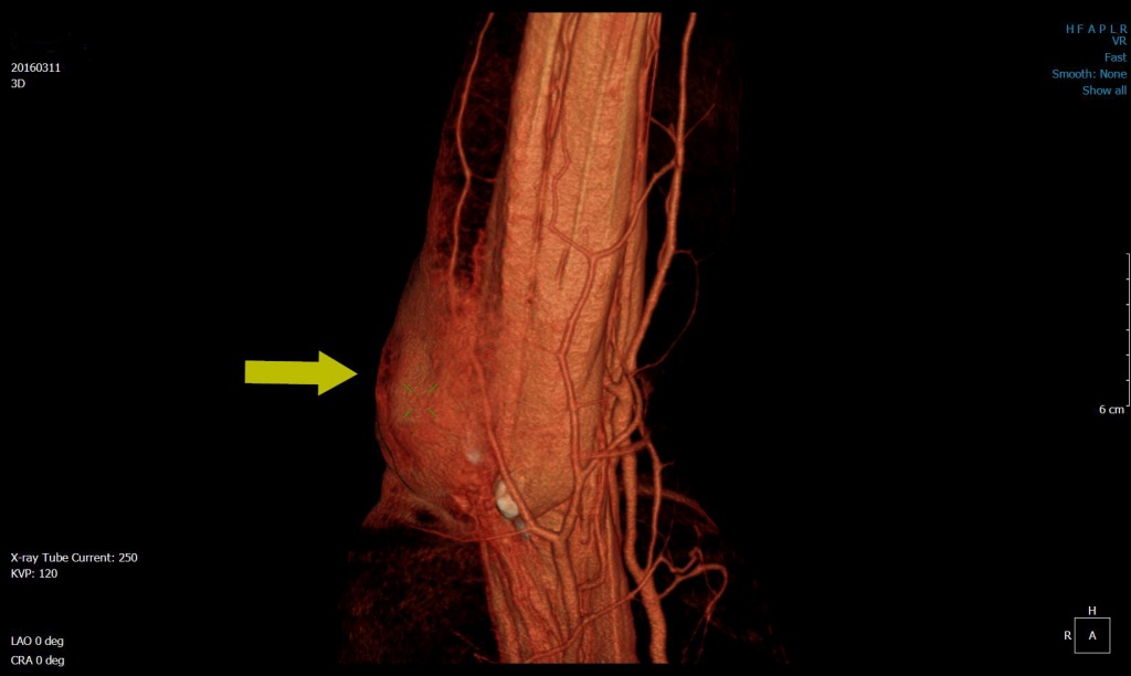 Преимущества 3D технологий при Компьютерной Томографии сосудов и мягких тканей