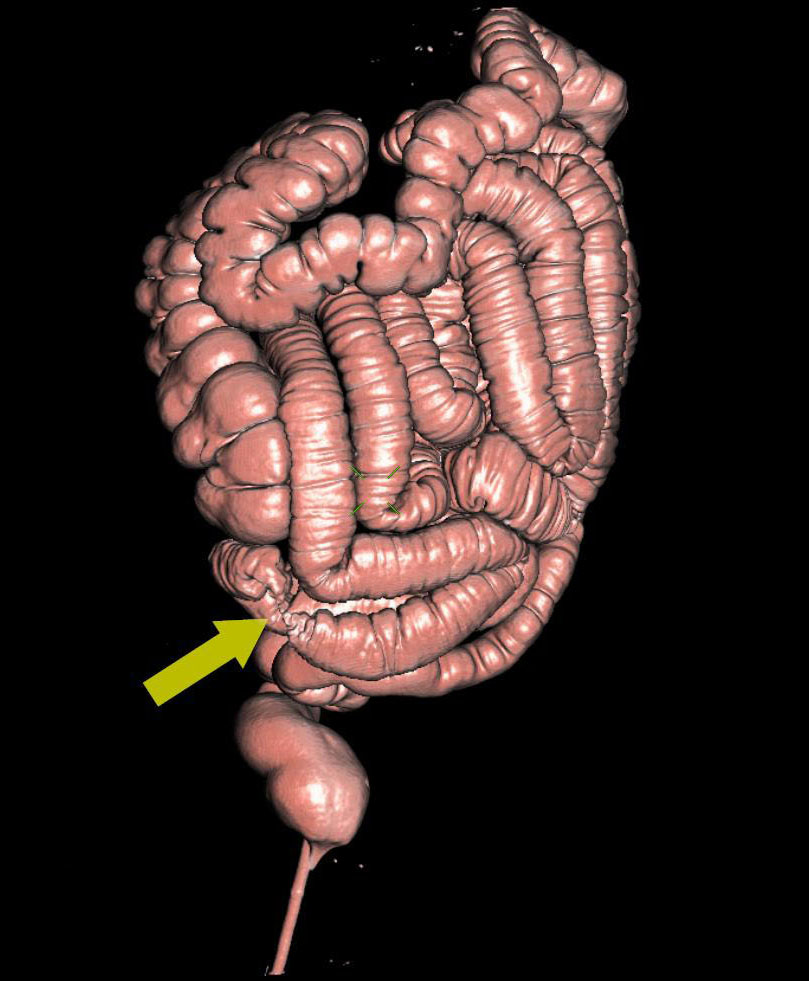 3D- реконструкция при исследовании пищеварительной системы: (Виртуальная гастро; колоноскопия)
